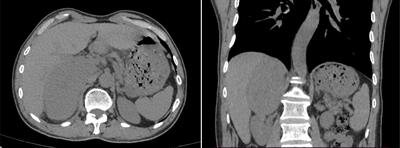 Imaging findings of primary epithelioid sarcoma of adrenal gland: a case report and literature review